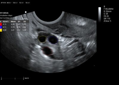Auto Follicle