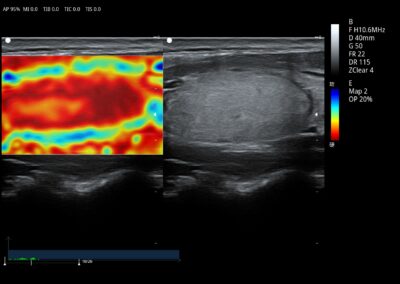 Elastograpia
