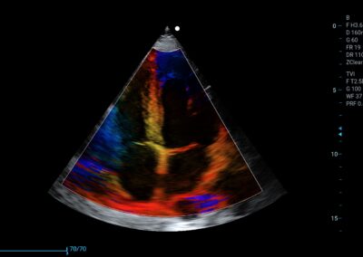 Serce z kolorowym Dopplerem