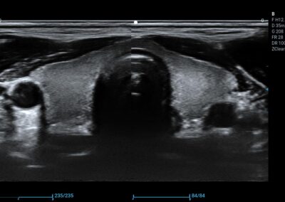 Tarczyca - głowica liniowa
