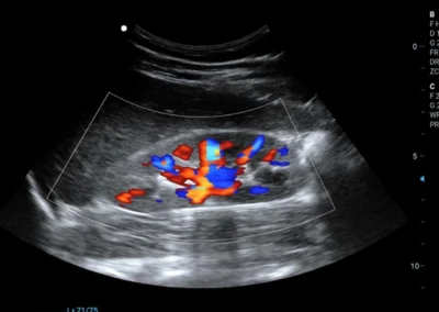 Nerka - głowica Convex