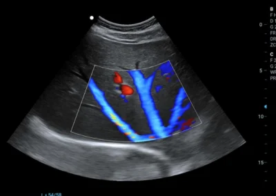 Wątroba - głowica Convex