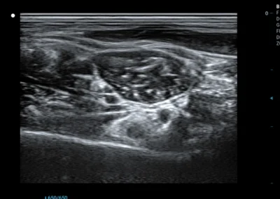 Splot ramienny - głowica liniowa