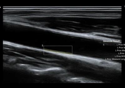 CCA-IMT Tętnica szyjna